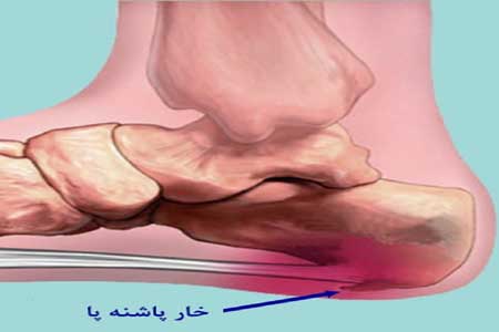 عکس خبري -راه‌ هاي درمان خار پاشنه پا بدون جراحي